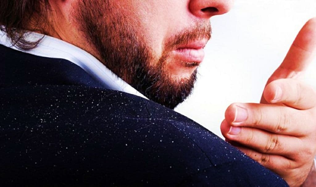 Man with Dandruff
